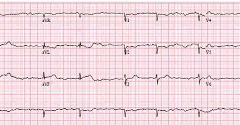 Dr Smiths Ecg Blog A Woman In Her 60s With Vfib Arrest And No Stemi
