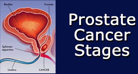 One reason for this is the way the cancer grows. Prostate Cancer Signs and Symptoms. Diagnosis, Stages ...