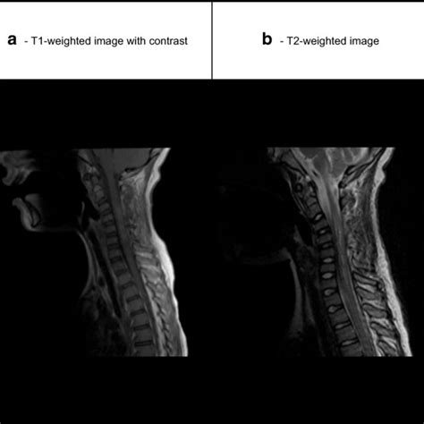 Preoperative Sagittal MRI Of The Cervical Spinal Cord A T Weighted Download Scientific