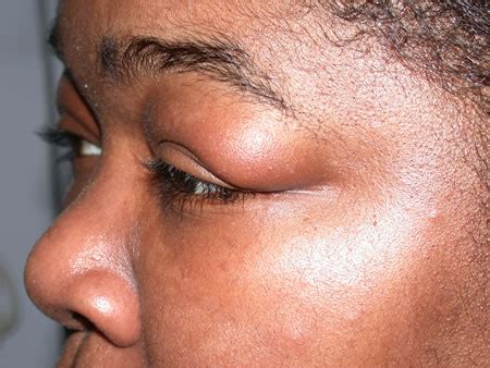 Swollen Eyelid Causes Symptoms Pictures Treatment Healthmd