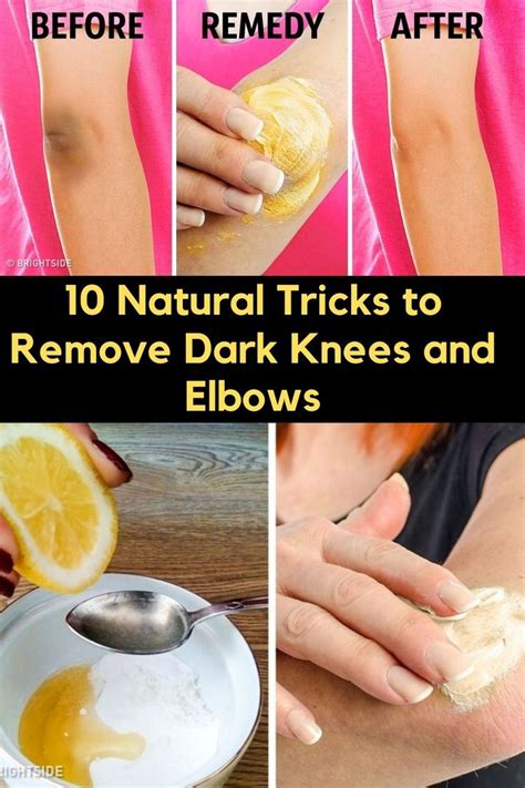 10 Natural Tricks To Remove Dark Knees And Elbows Organic Skin Care