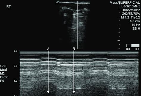 Lung Sliding Ultrasound