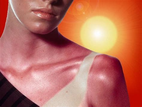 How To Treat Your Sunburn Four Tips From A Dermatologist