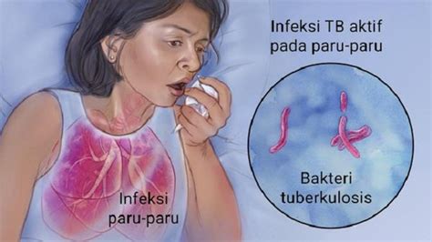 Kenali Penyakit Tbc Dan Tahapan Penularannya Suara Surabaya