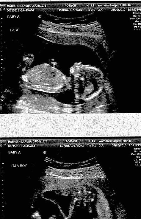 The Matherne Quads 16 Week Ultrasound Baby A Its A Boy
