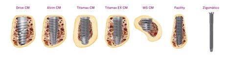 Implantes Braga Odontologia