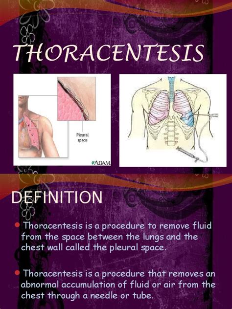 Thoracentesis Respiratory System Clinical Medicine