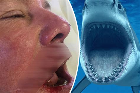 Shark Attack Dentist Ambushed By Monster Beast In Bahamas Has Horror