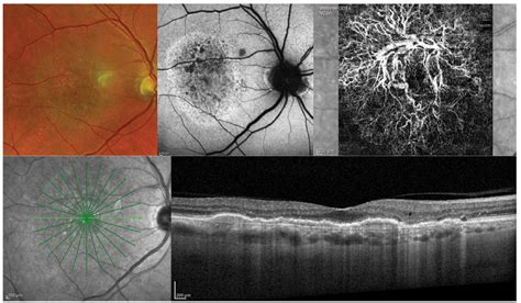Retinal Imaging See More Than Ever Before
