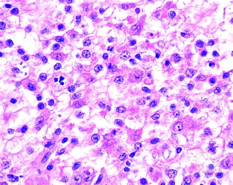 Sinus Histiocytosis With Massive Lymphadenopathy 3