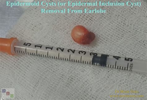 Removal Of Earlobe Cyst