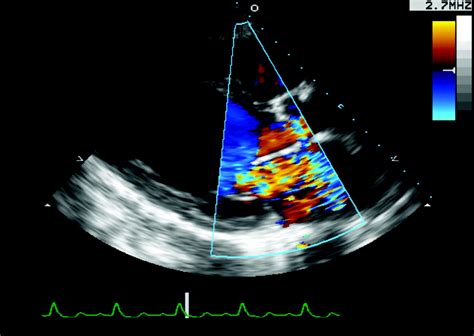 Radiation Induced Heart Disease Heart