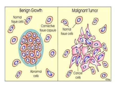 Benign Tumor Pictures