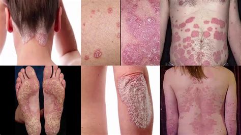 Scales are very painful and itchy and sometimes it can be bleed or split into pieces. Psoriasis Home Remedies | Best Natural Home Remedies To ...