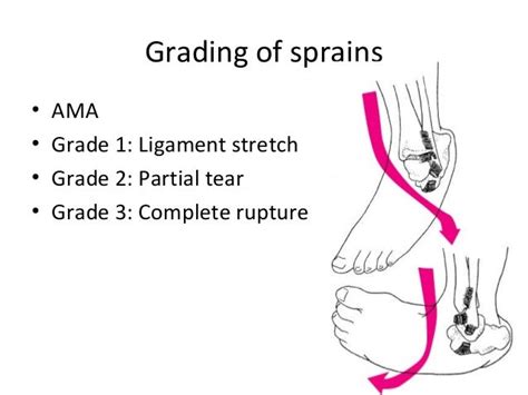 Grade 2 Ligament Sprain When Will Rgiii Return From A Sprained
