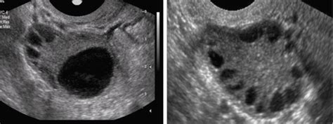 Normal Vs Polycystic Ovaries Ultrasound