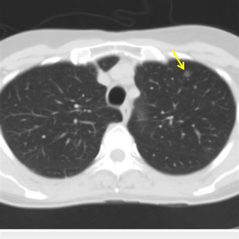 CT Scan Of The Chest Demonstrating A Mm Left Upper Lobe Pulmonary Download Scientific Diagram