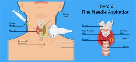 Fine needle aspiration biopsy (fna) is a routine diagnostic technique for evaluating thyroid nodules. Hypothyroidism Diagnosis - Drug Genius