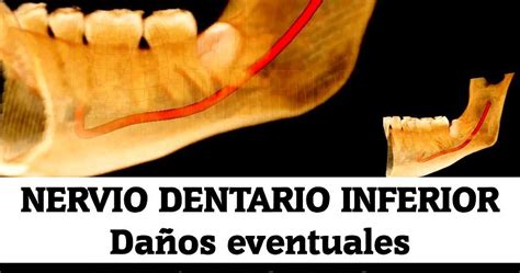 Nervio Dentario Inferior Daños Eventuales Dr Rafael Ruíz Rodríguez