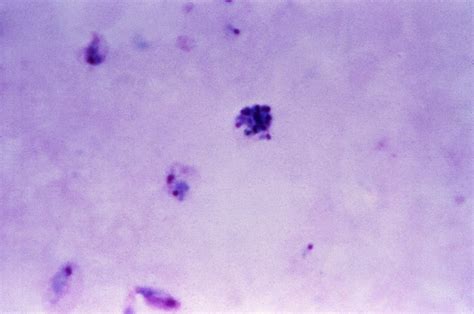 Free Picture Thick Film Micrograph Mixed Falciparum Malariae Parasitic Infection