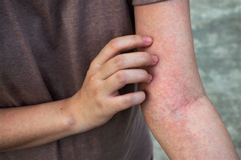 Skin Rashes Skin Infection • Houma And Bayou Vista La • Delta Urgent