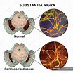 Illustration of healthy and degenerated substantia nigra of human ...