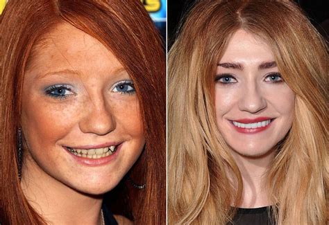 Celebs With Bad Teeth How Far Did They Go Their Dental Implants Cost