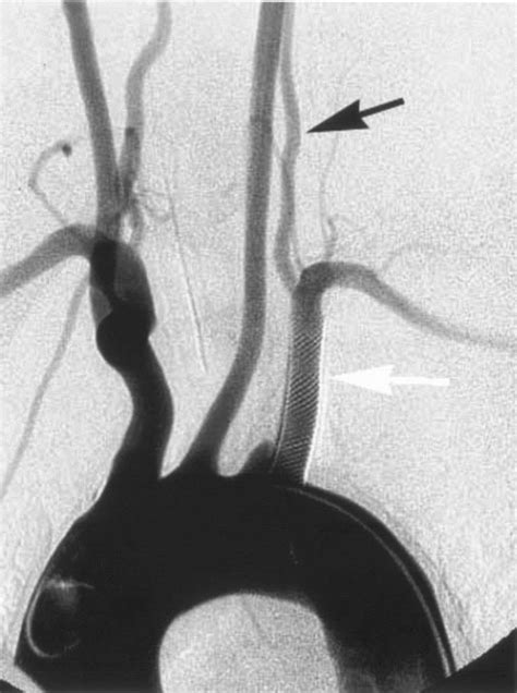 Arteriogram Of The Aortic Arch After Stent Placement White Arrow