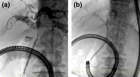 Partial Stent‐in‐stent Placement Using Uncovered Metal Stents With A