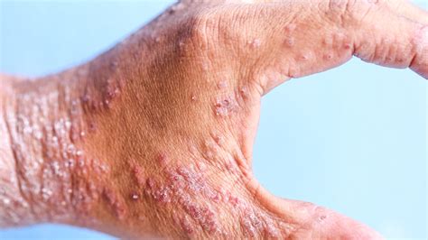 Dermatitis Atópica Fundación Mexicana Para La Dermatología Ac