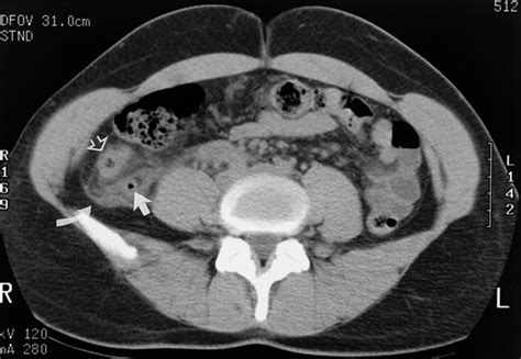 Peritonitis Acute Diseases And Conditions 5minuteconsult