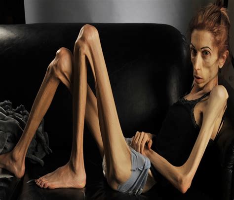 Anorexia Nervosa Causes Symptoms Treatment Diagnosis