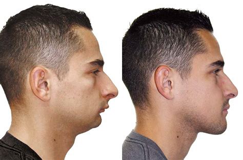 Upper Lower Jaw And Chin Forward Orthognathic Surgery