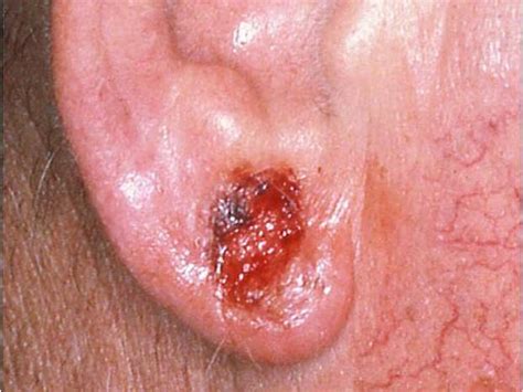 Basal Cell Carcinoma On The Ear Skin Cancer Or Mole How To Tell