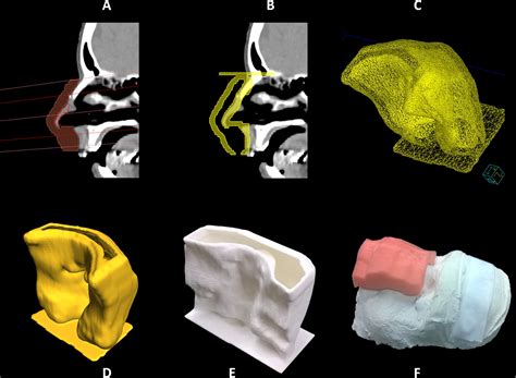 Clinical Implementation Of 3d Printing In The Construction Of Patient