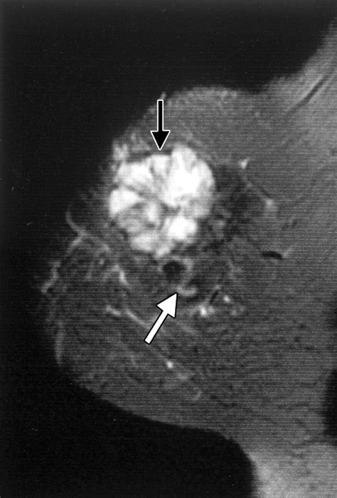 Mr Imaging Of Mucinous Carcinoma Of The Breast Ajr