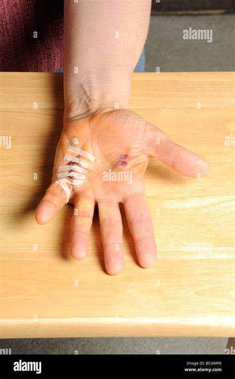 Dupuytrens Contracture After Surgery Stock Photo Alamy
