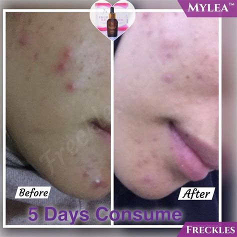 Mylea freckles serum original murah berkesan. Miss DeL: MYLEA FRECKLES SERUM