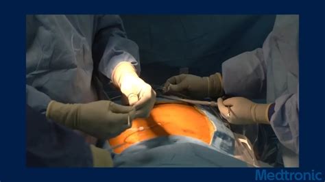 Peritoneal Dialysis Video Laparoscopic Insertion Technique Medtronic