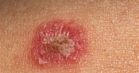 Psoriasis Or Ringworm Symptoms Treatment And Other Rashes