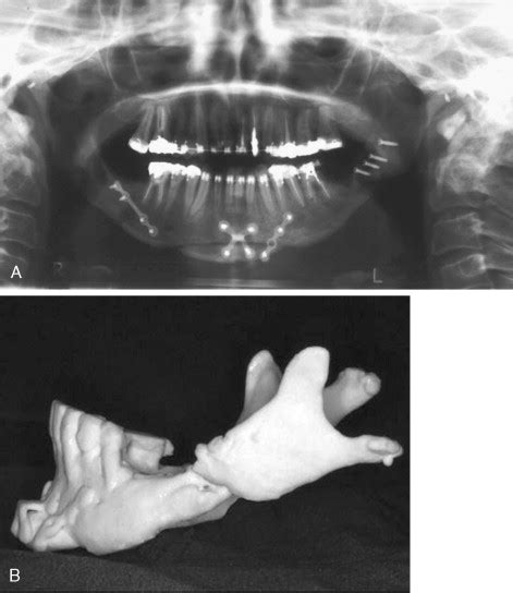 Complications With Orthognathic Surgery Pocket Dentistry