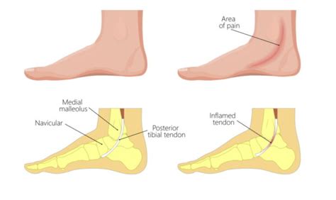 Posterior Tibial Tendonitis A Cause Of Flat Foot Sport Doctor London