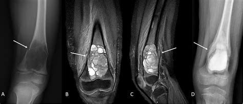 Cureus Aneurysmal Bone Cyst Of The Distal Femoral Metaphysis In A