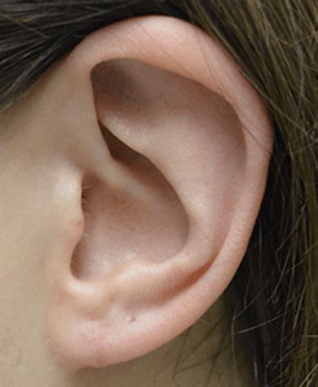 Specialist Earlobe Repair Clinic Sydney Gauged Stretched Enlarged