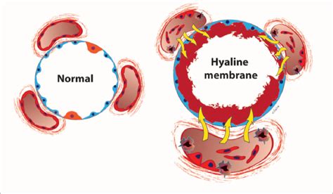 Pathogenesis Of Hyaline Membrane Disease HMD Vascular Disruption