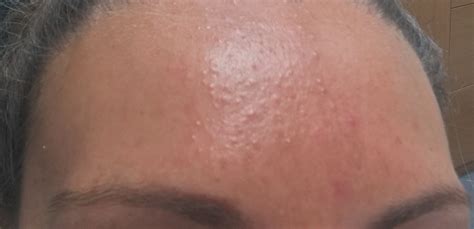Small Colourless Bumps On My Forehead General Acne Discussion Acne Org Forum