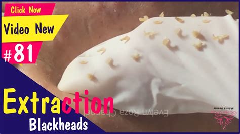 Extraction Blackheads Under Skin Acne Treatment 81 Youtube