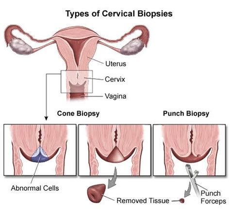 A Cervical Biopsy Is A Surgical Procedure In Which A Small Amount Of Tissue Is Removed From The