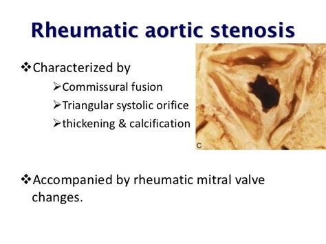 Echo Assessment Of Aortic Stenosis