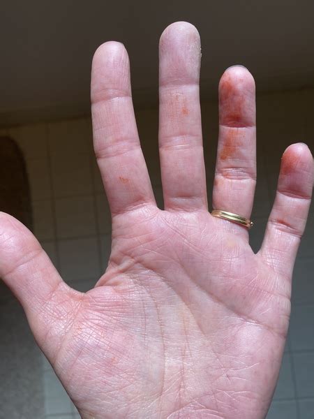 What Are These Orange Stains That Have Appeared On My Hands Overnight